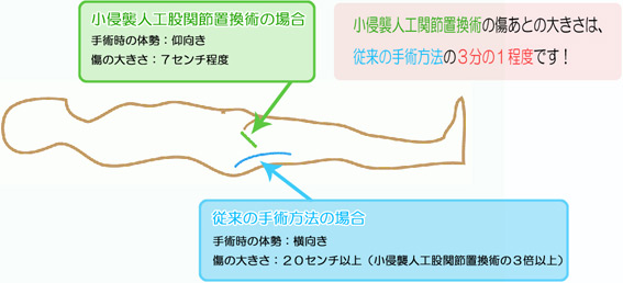 傷あとの小さな手術 小侵襲人工股関節置換術の傷あとの大きさは、従来の手術方法の3分の1程度です!