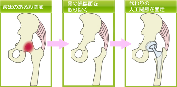 小侵襲人工股関節置換術の流れ 疾患のある股関節→骨の損傷面を取り除く→代わりの人工関節を固定