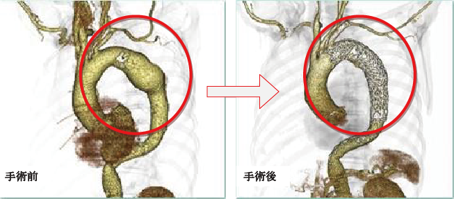 胸部大動脈に対するステントグラフト内挿術と施行