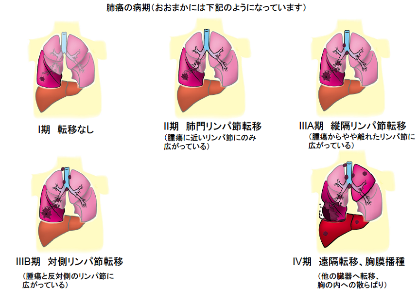 肺癌の診断法