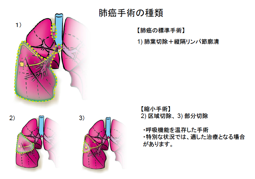 肺癌手術の種類