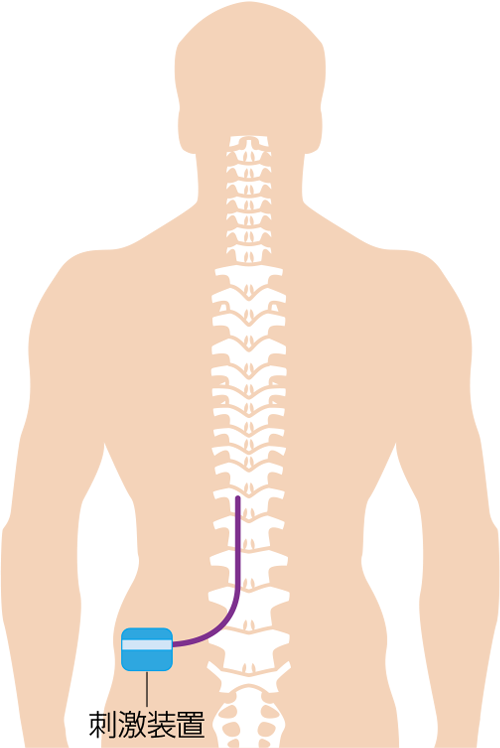 脊髄刺激療法のイメージ