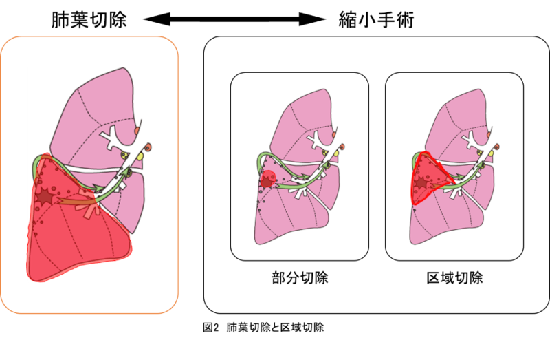 図2_肺葉切除と区域切除