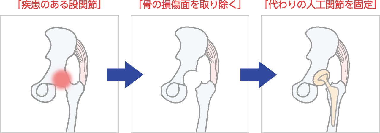人工関節装着図