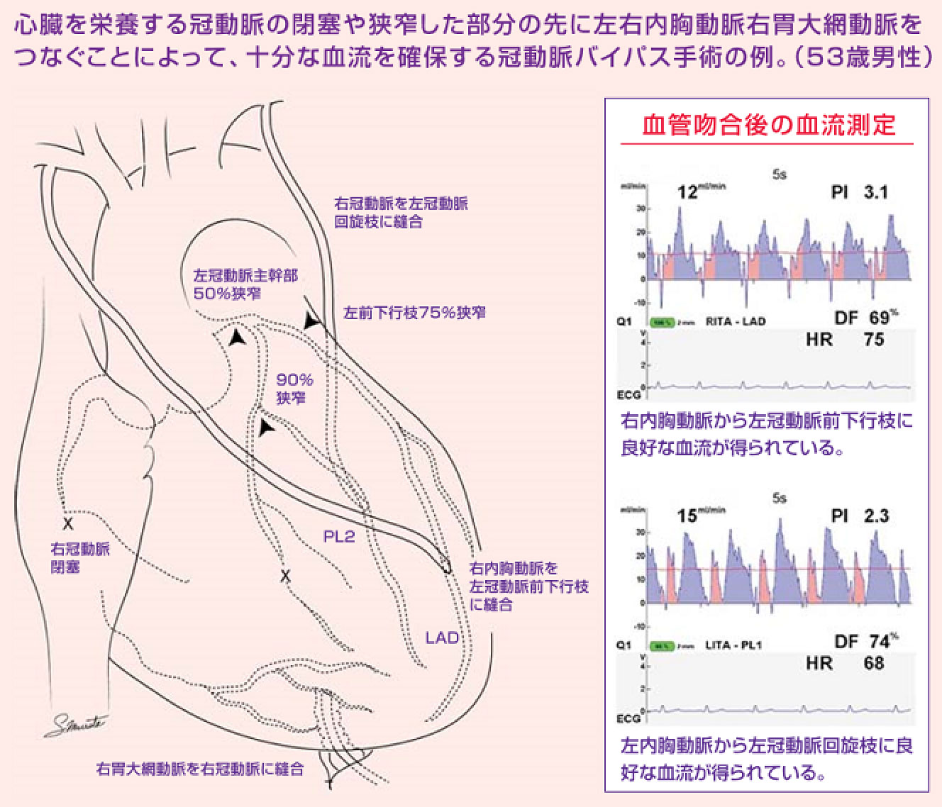 人工心肺装置を使用しない心拍動下冠動脈バイパス手術